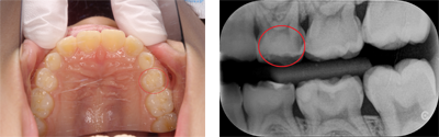 虫歯症例2