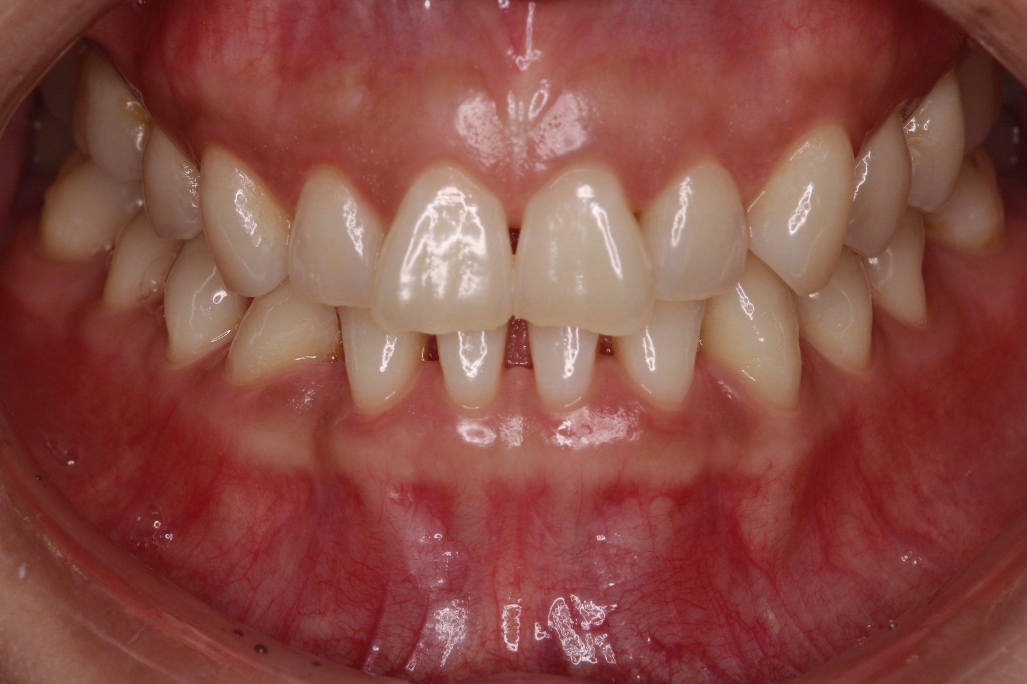 メーカー公式 ラテックスダム 小型レジンボンディングダム 歯の漂白用歯の使用歯の修復歯の固定 5 52 sheets in a box awexomelabs.com