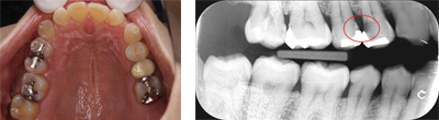 虫歯症例1